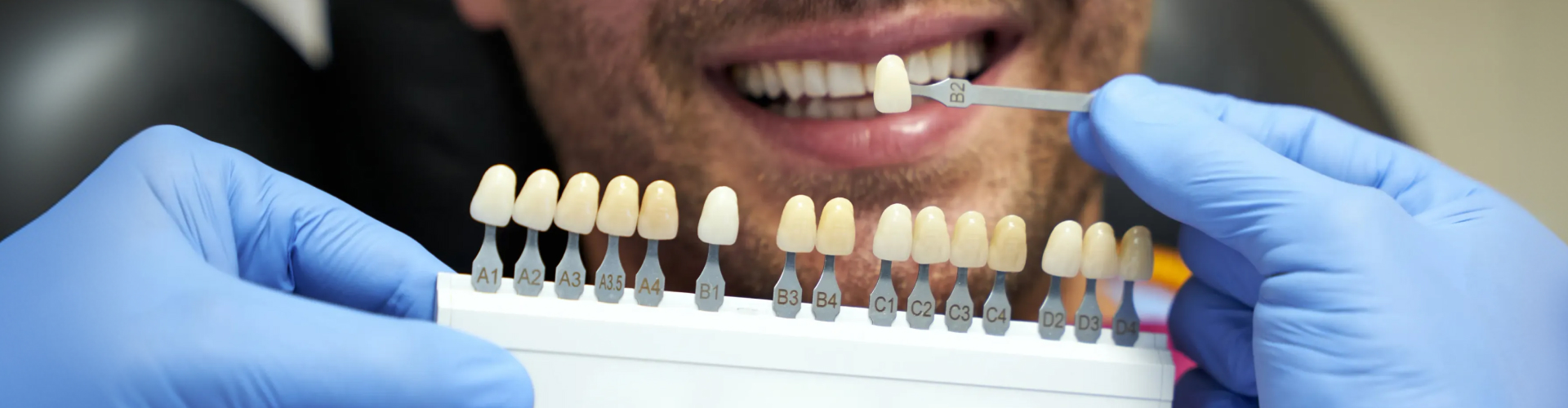 Dentist matching a veneer shade to a patient's natural teeth using a dental shade guide before cosmetic treatment.